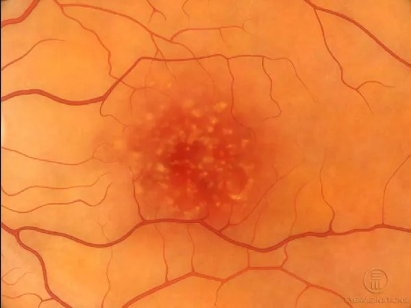 Degeneración_Macular_relacionada_a_la_edad